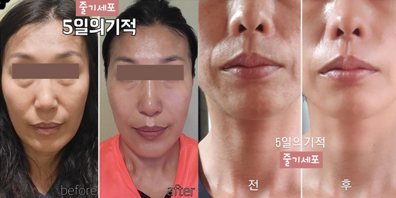 엘에이 울쎼라 리프팅, 엘에이 동안케어, 엘에이 피부재생 스킨케어